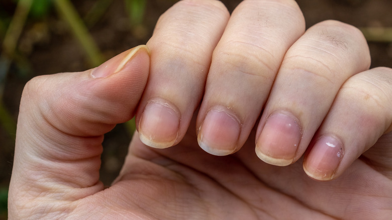 Weak brittle discolored nails