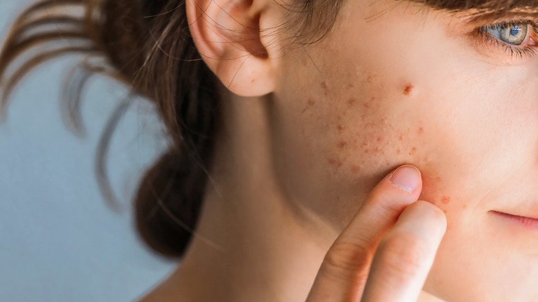 woman with acne