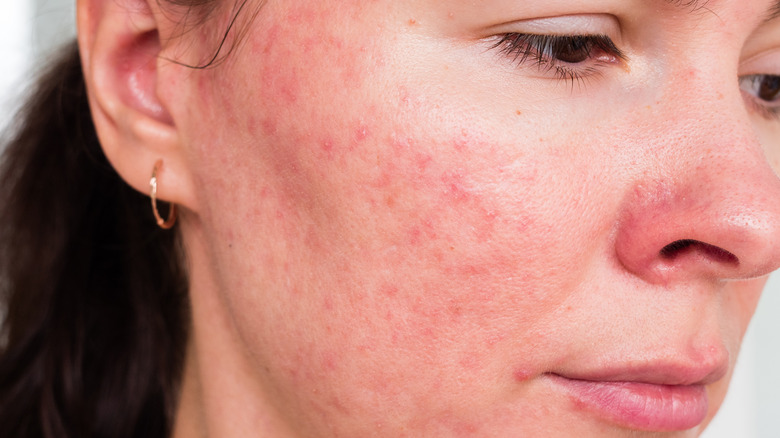 woman with spots on face