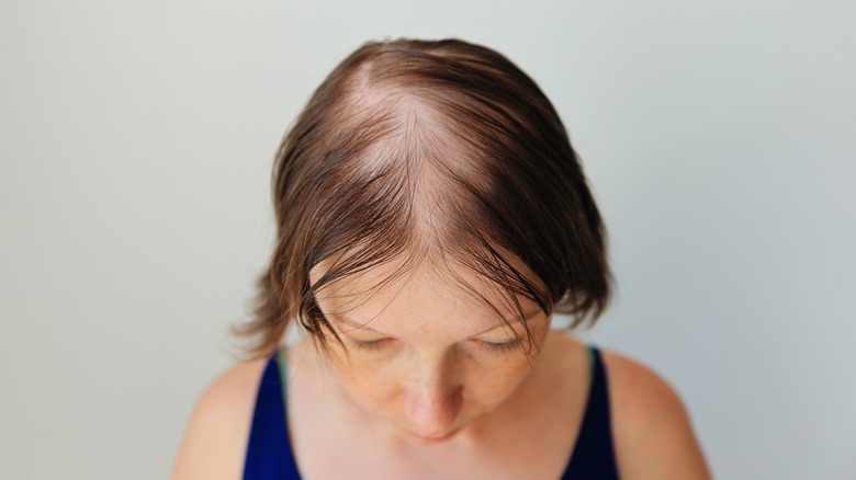 Female hair loss example