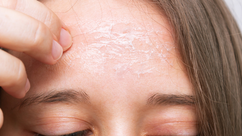 Woman touching dry forehead skin