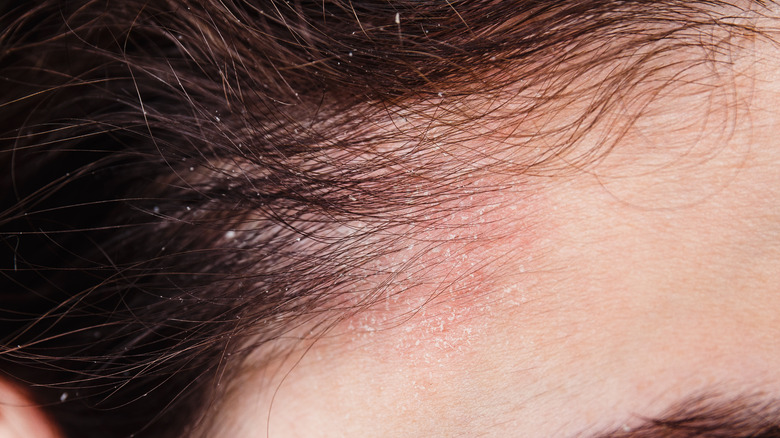 woman with scalp eczema