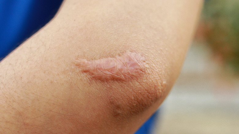 woman with keloid scar