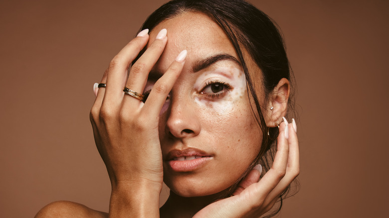 woman with facial vitiligo