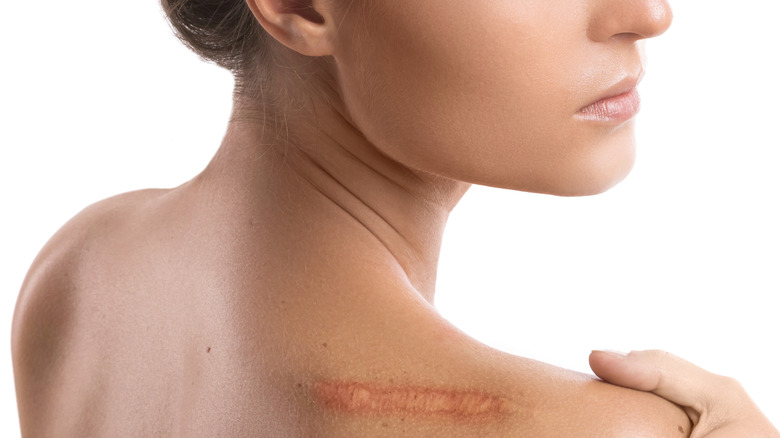 woman with shoulder scar 