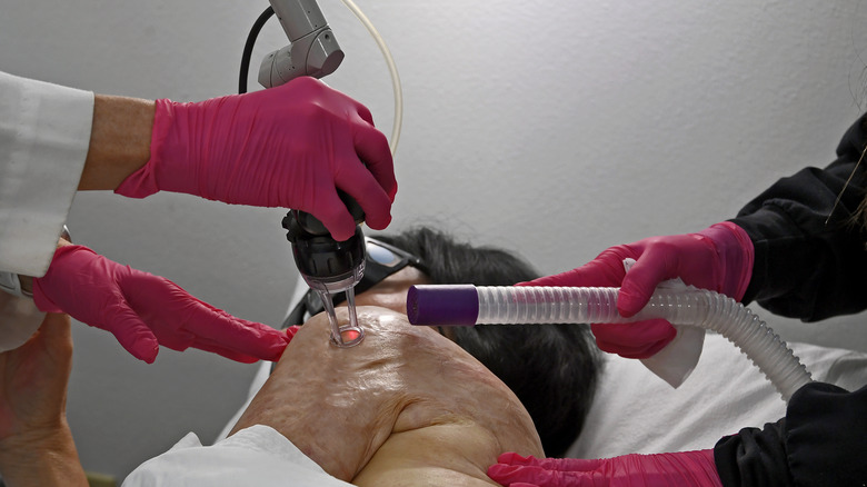 woman undergoing laser treatment