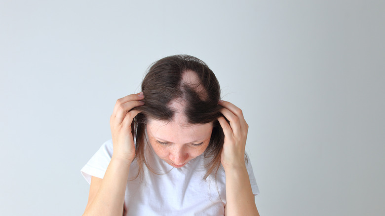 Girl with hair loss