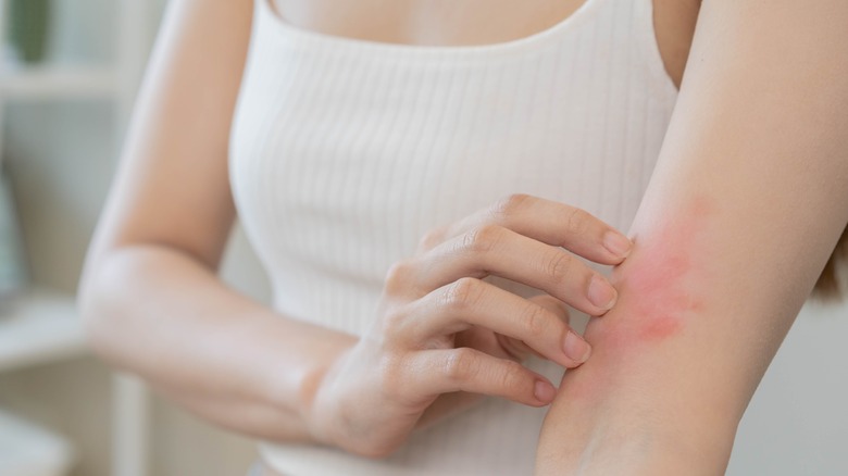 Woman scratching red, irritated arm