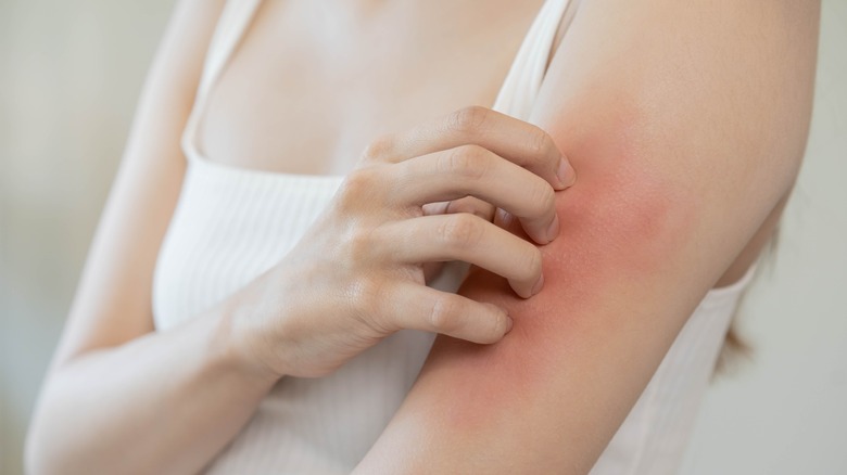 Woman scratching irritated skin