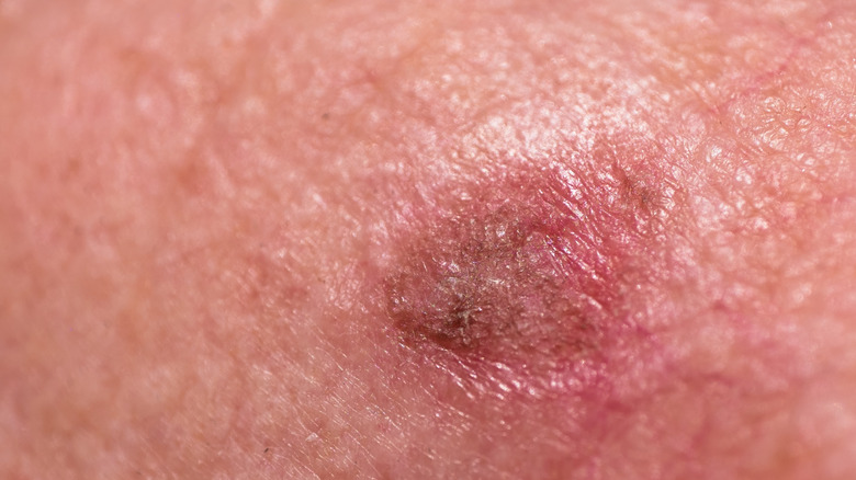 actinic keratosis growth