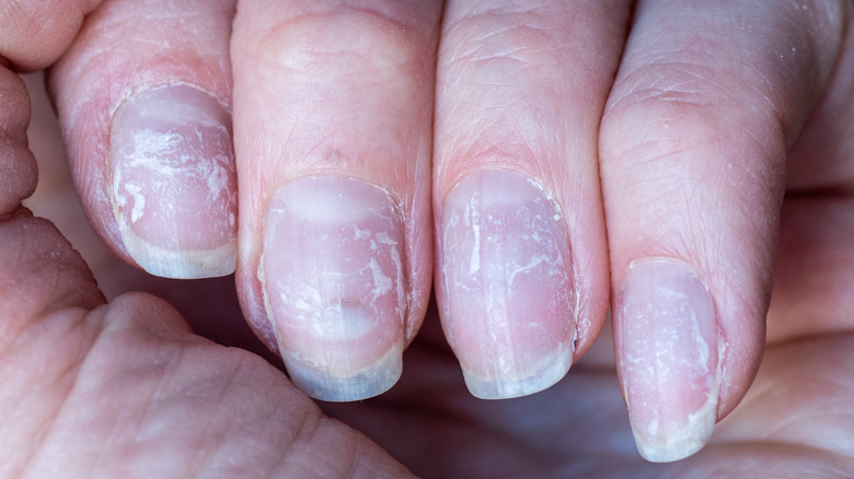 woman with damaged nails 