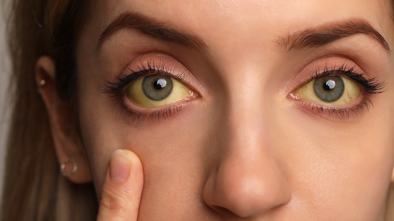 Woman with jaundice yellow eyes