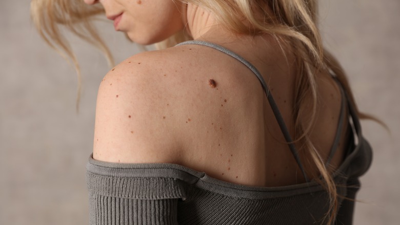 Woman with moles on her back