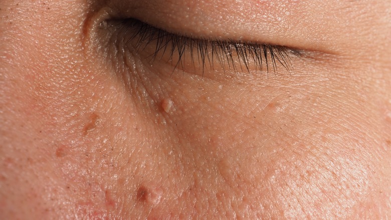 Closeup of skin tags near eye