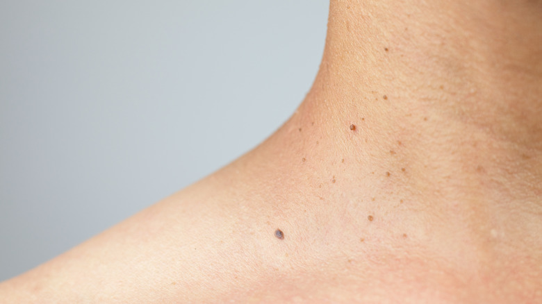 Neck with moles and skin tags