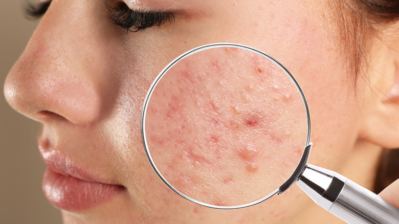 close up on acne cluster