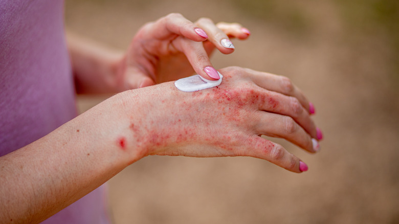 woman applying eczema on hands