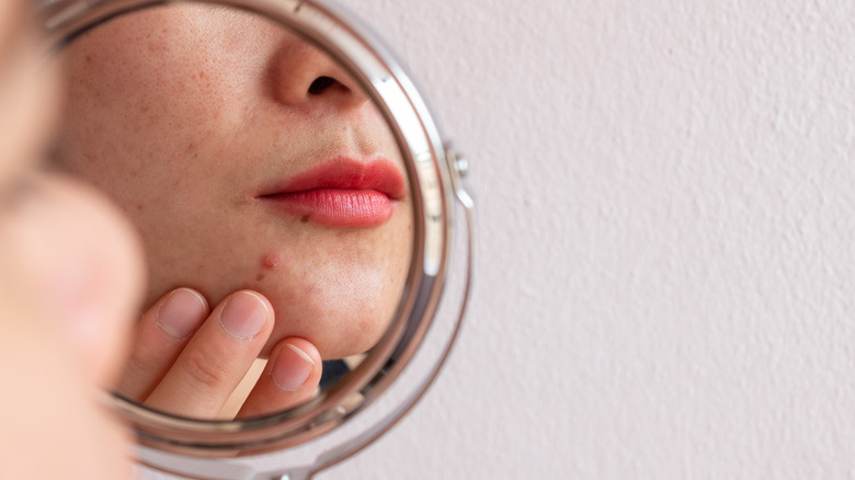 Woman with breakout, looking in mirror