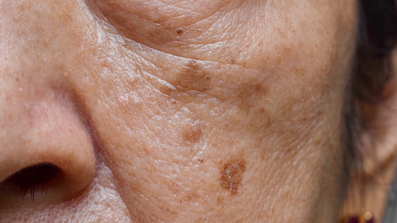 close up of age spots on face