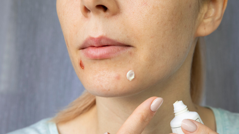 woman putting cream on pimples