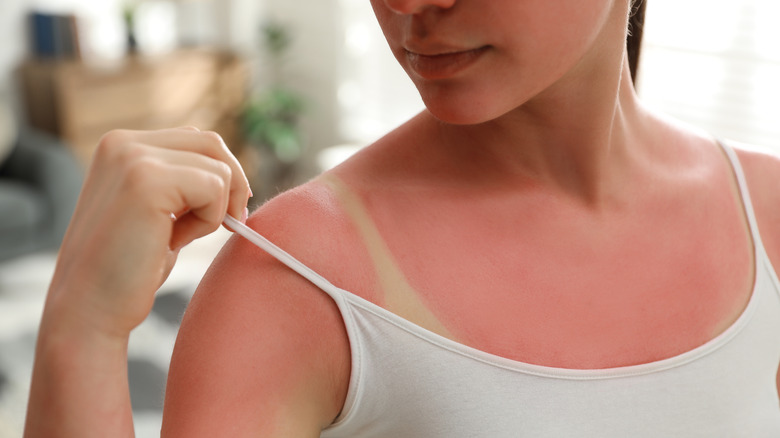 Woman with severe sunburn