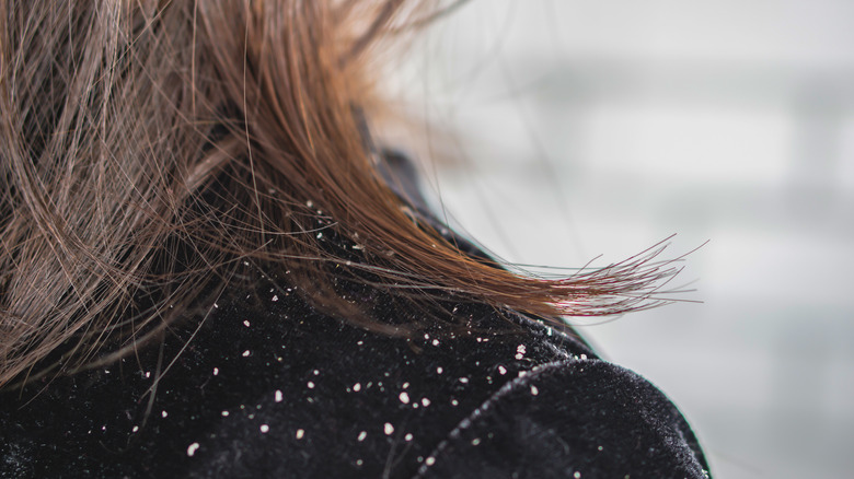 Woman with dandruff on shoulders