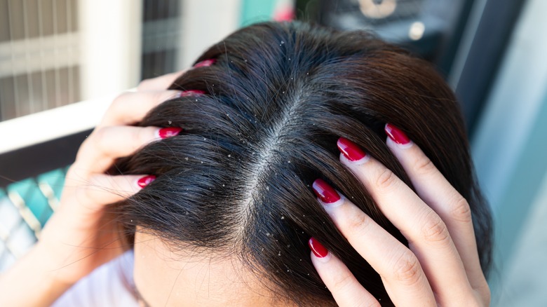 Scalp with dandruff