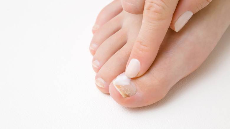 Applying cream to damaged nail