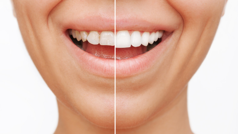 Before and after dental veneers