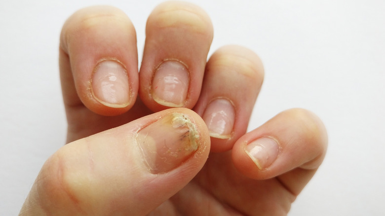 Nails damaged by gel polish