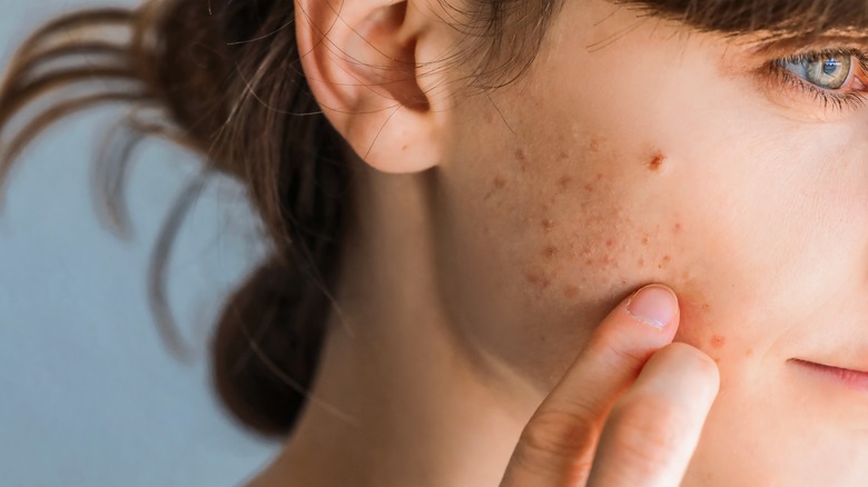 woman with eczema on face