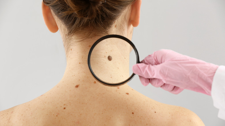 inspecting mole on woman's neck