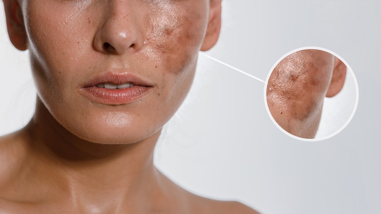 skin pigmentation on face