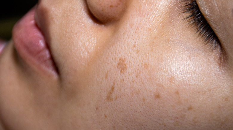 hyperpigmentation on woman's face 