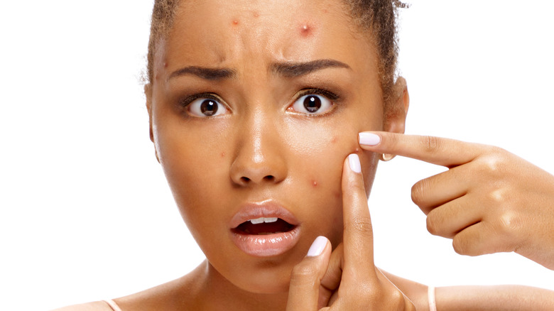 girl points to pimples on face