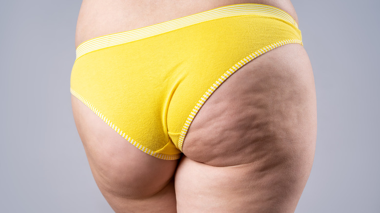 Moderate cellulite on bum