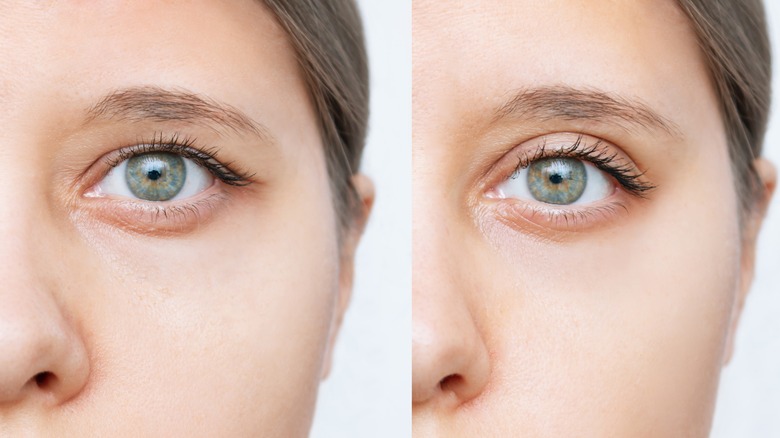 Before and after blepharoplasty