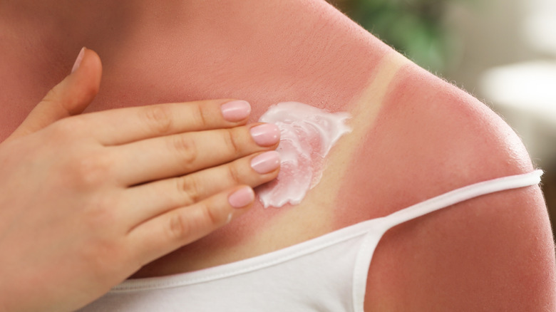 woman applying cream on sunburn