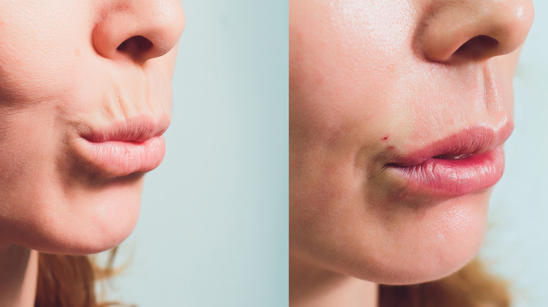 woman before and after upper lip threading 
