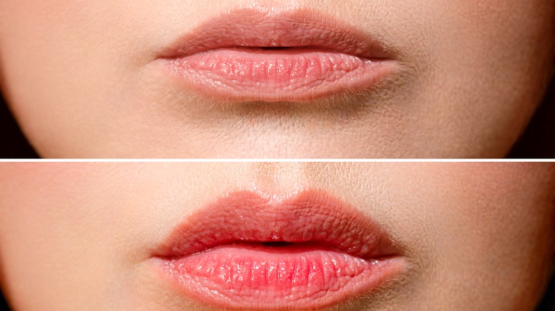 woman before and after lip procedure 