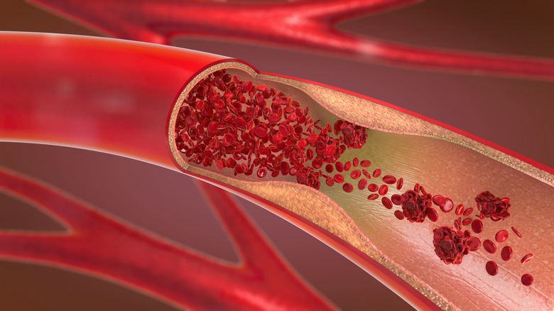 narrow artery with low circulation