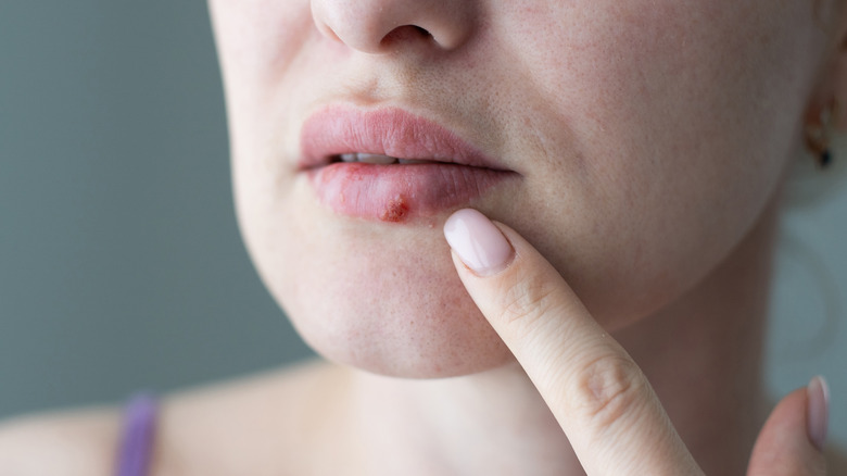 person with a cold sore