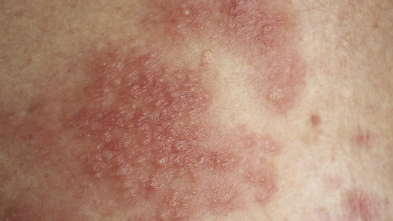 Eczema looks like it hurts -- because it does
