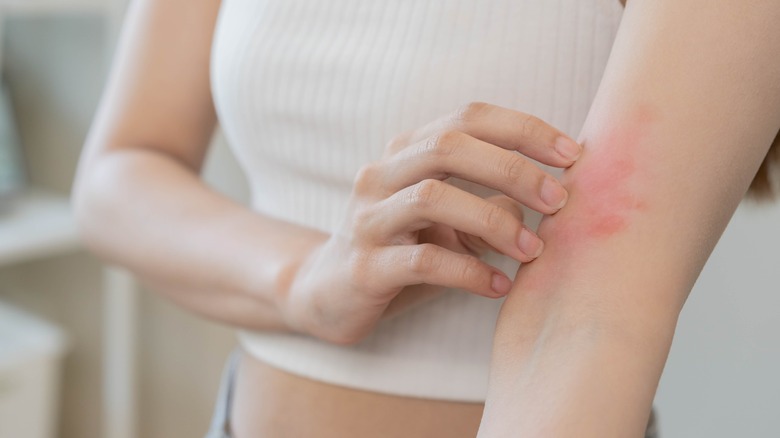 Woman with a skin rash