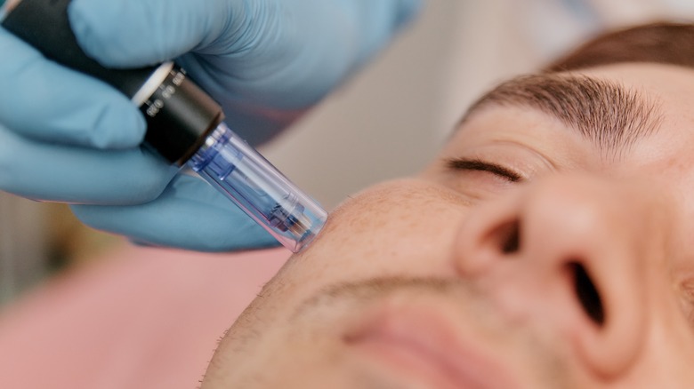 Man receiving microneedling treatment