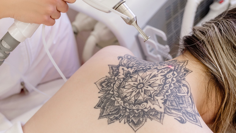 Lasering tattoo off woman
