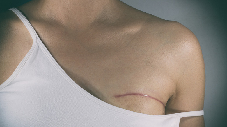 Woman with a scar on her breast