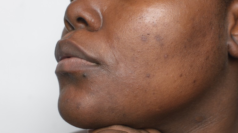 woman acne scars and discoloration