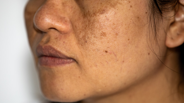 Hyperpigmentation