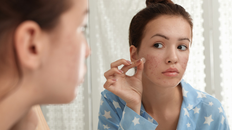 Girl applying pimple patch to acne breakout